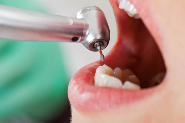 Best Emergency Tooth Extraction in Crestwood, KY
